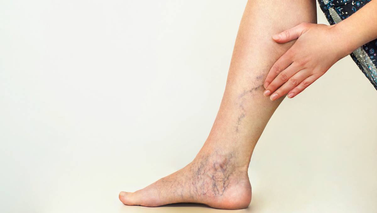 What To Look For In A Sydney Spider Vein Clinic