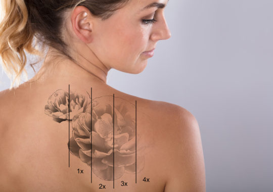 Things You keep In Mind Before Tattoo Removal