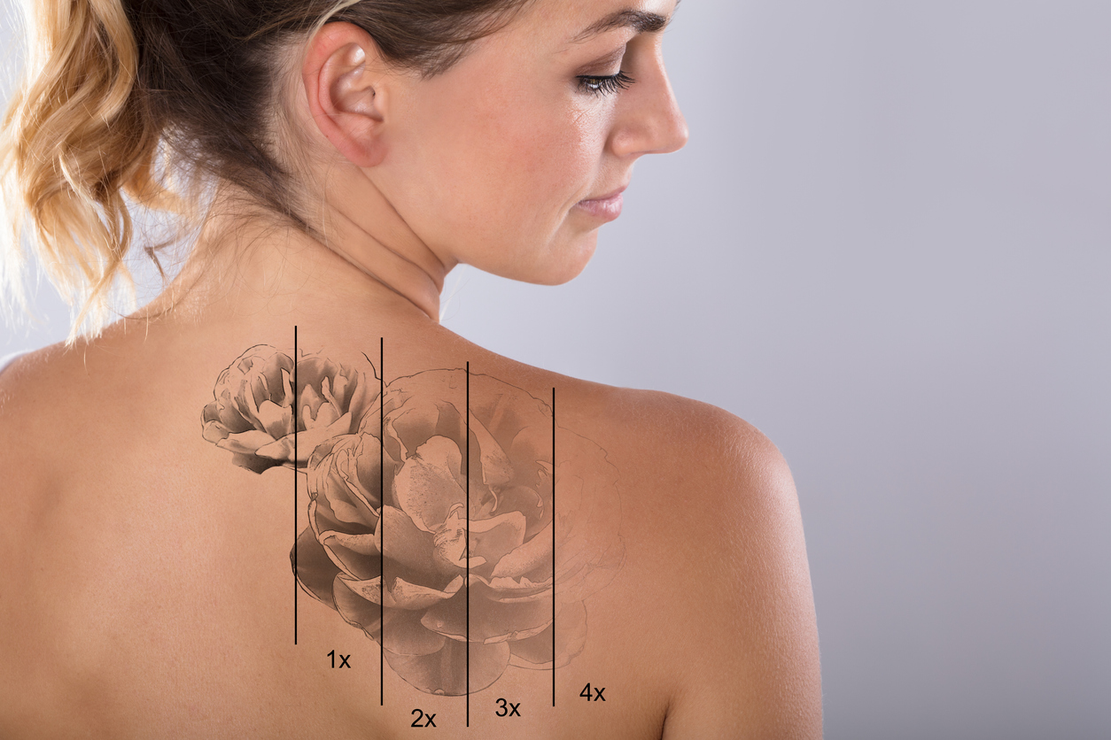 Things You keep In Mind Before Tattoo Removal