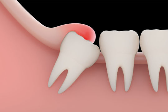 Wisdom Teeth: How To Know If Something Isn’t right