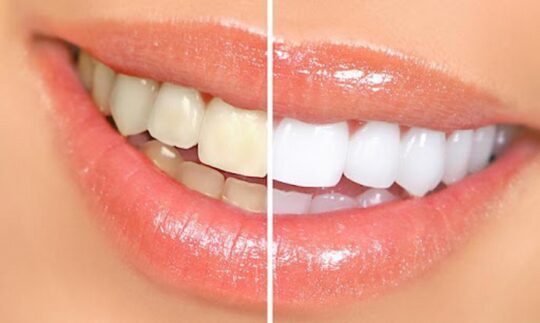 Some Safe Methods Of Professional And At-Home Teeth Whitening
