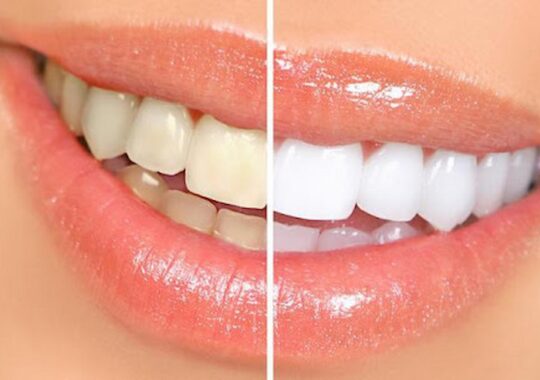 Some Safe Methods Of Professional And At-Home Teeth Whitening