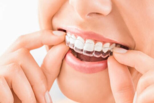 Reasons Why Invisalign Is A Right Decision For Straightening Your Teeth?