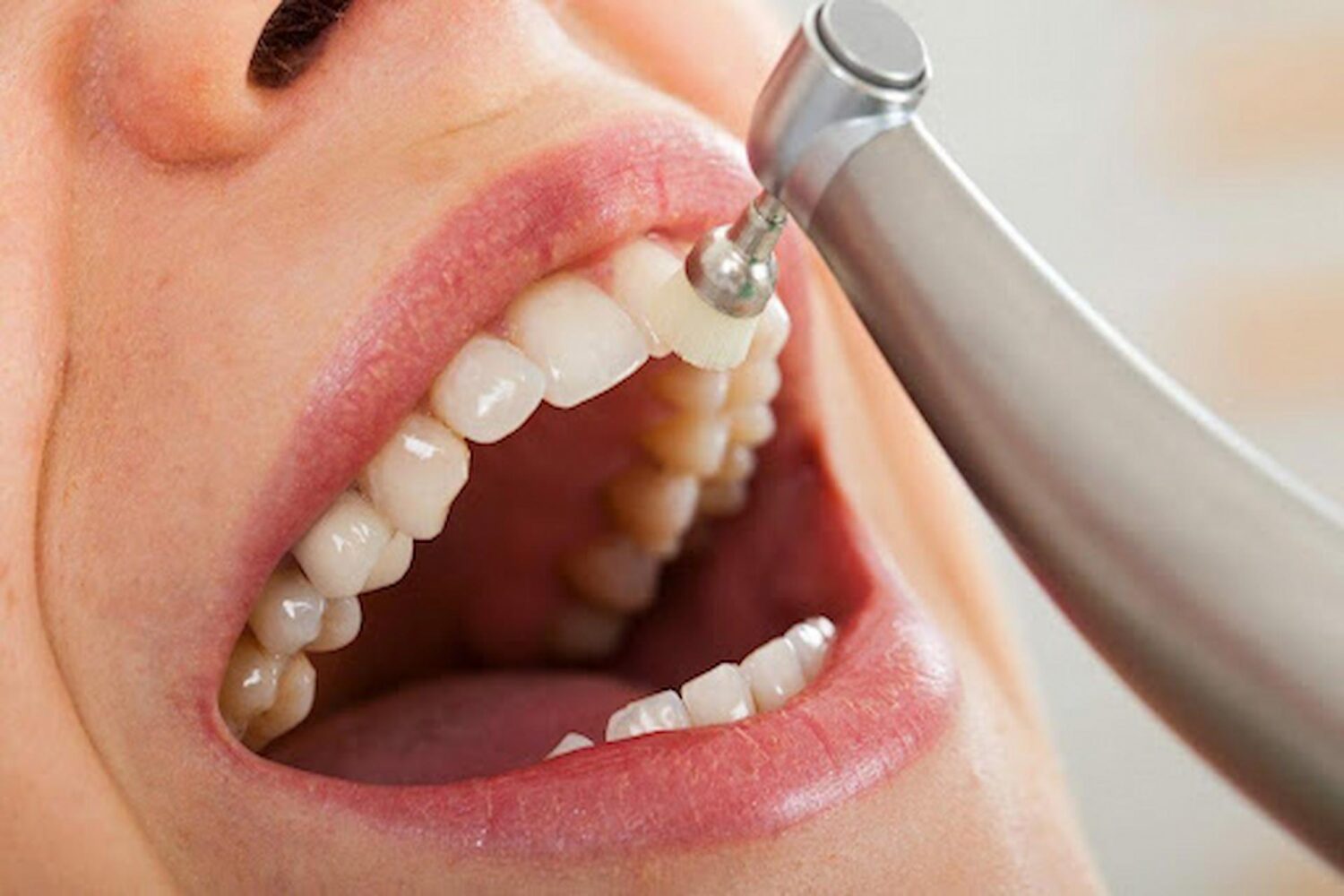 From Stains To Shine: Teeth Whitening And Teeth Cleaning Explained