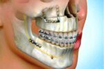 Treatment Of Jaw And Facial Fractures