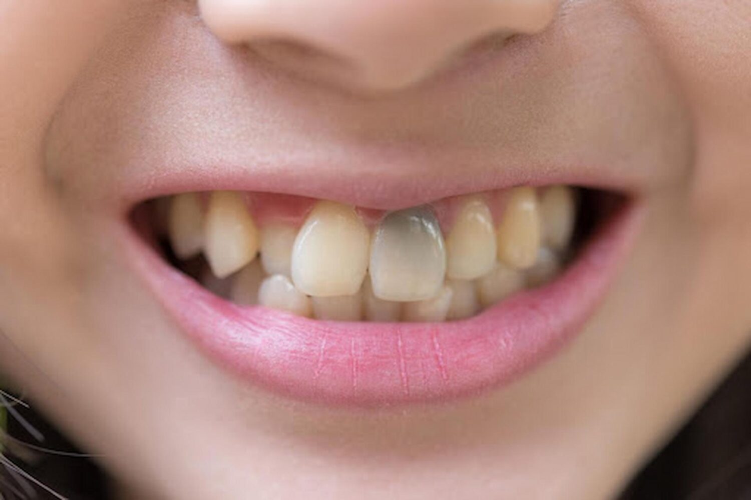 Can Teeth Whitening Change the Inside Color of Our Teeth?