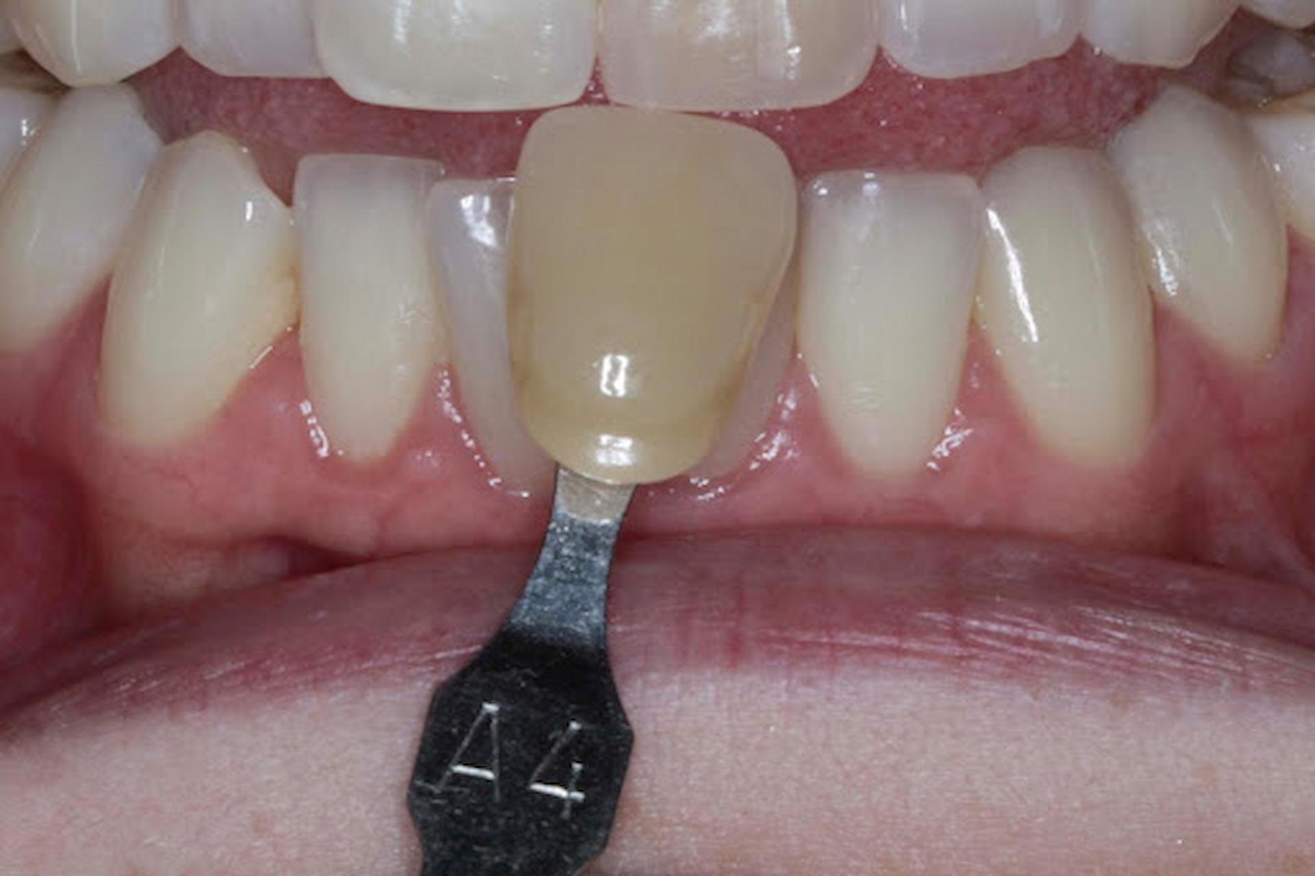 Teeth Whitening Method 