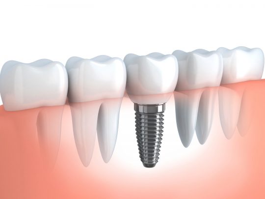 Should You Choose Dental Implants Or Bridges?